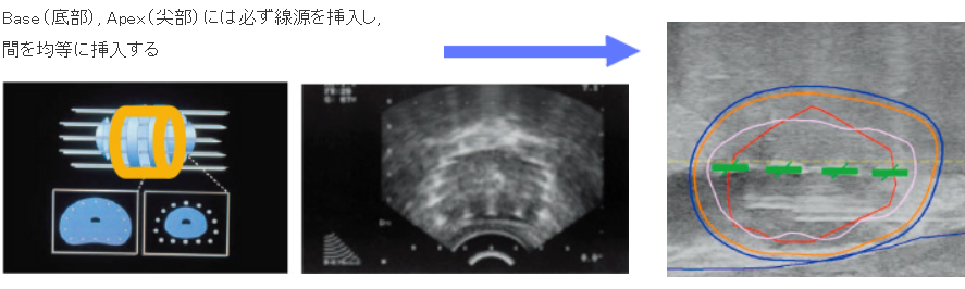 Peripheral Needles Placement_pc